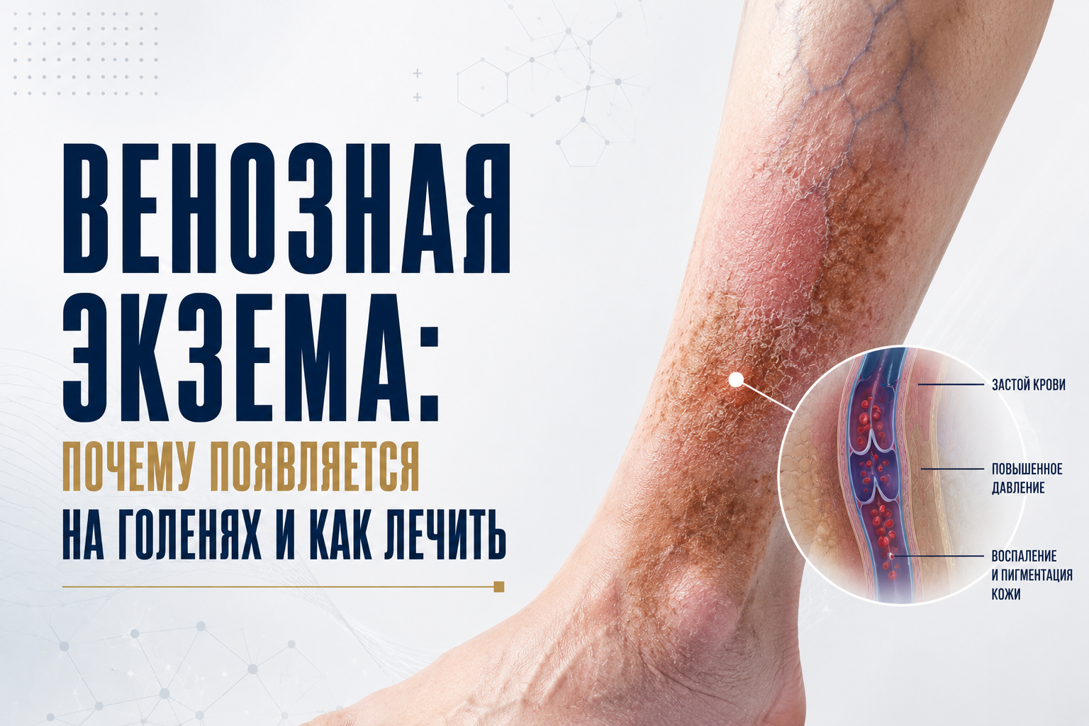 Венозная экзема: почему появляется на голенях и как лечить