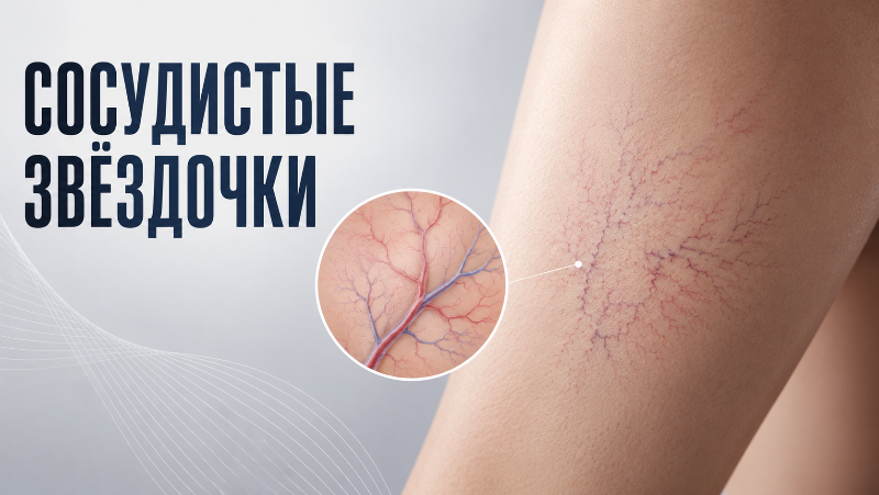 Сосудистые звёздочки: что это, почему появляются и как убрать