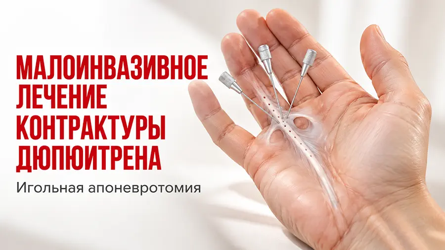 Операция при контрактуре Дюпюитрена