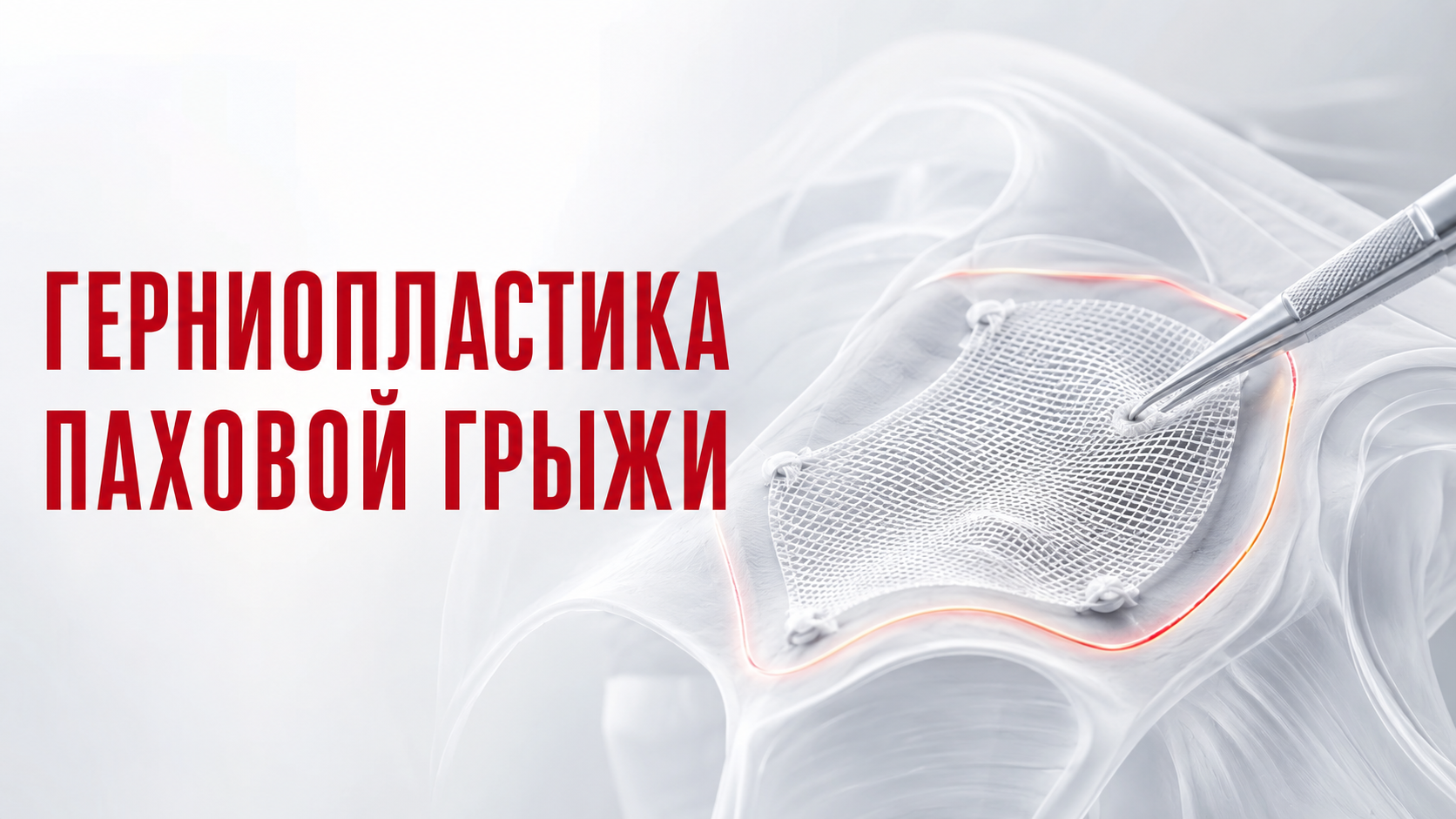 Герниопластика паховой грыжи