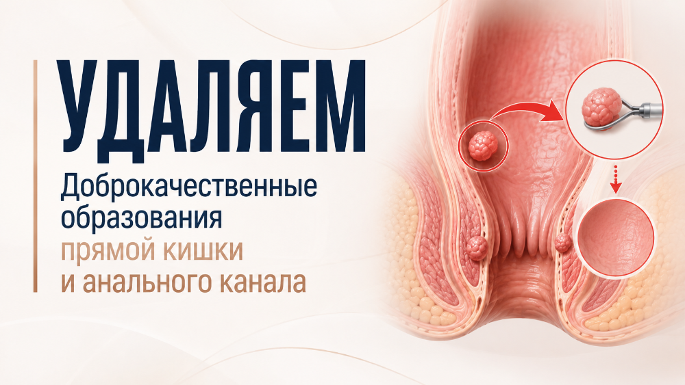 Удаление доброкачественных образований прямой кишки — Хабаровск