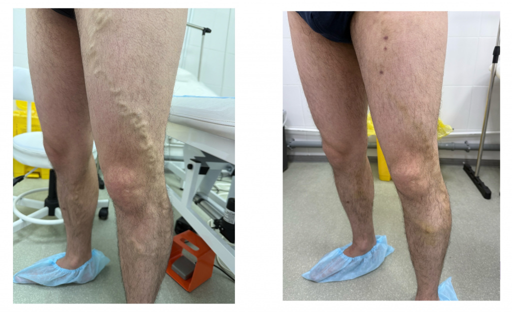 До и после ЭВЛК варикозных вен на ногах в Хабаровске — клиника Нефертити