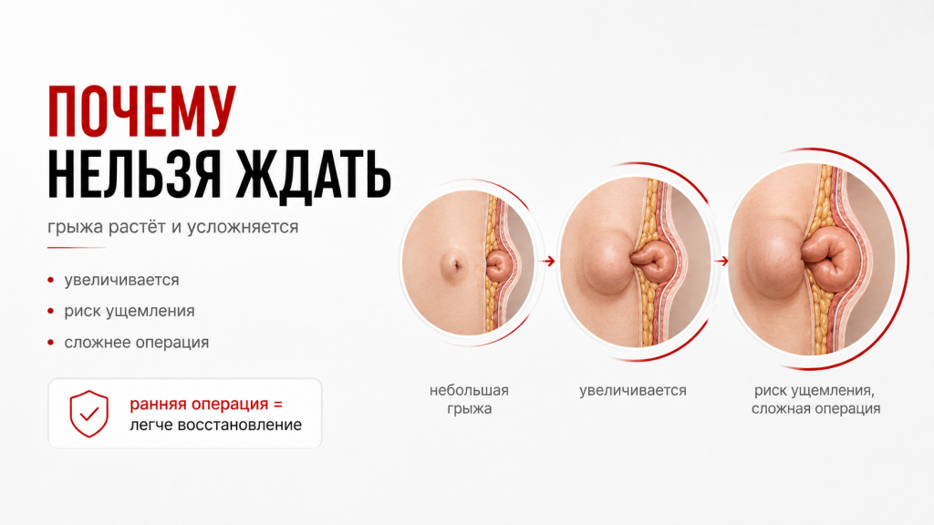 Пупочная грыжа у взрослых — схема выхода грыжевого мешка через ослабленное пупочное кольцо