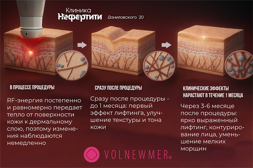 Распределение тепла при монополярном RF 6,78 МГц — объёмный прогрев (Нефертити, Хабаровск)