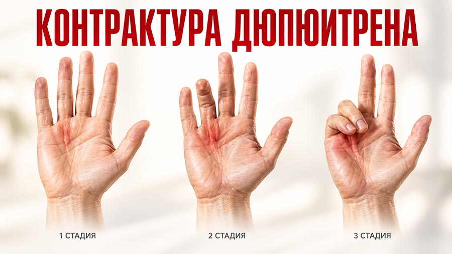 kontraktura-dyupyuitrena-stadii-khv.jpg kontraktura-dyupyuitrena-stadii-khv.jpg