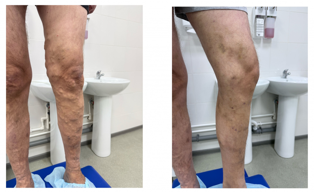 Результат лечения варикоза лазером Crystal в Хабаровске — до и после