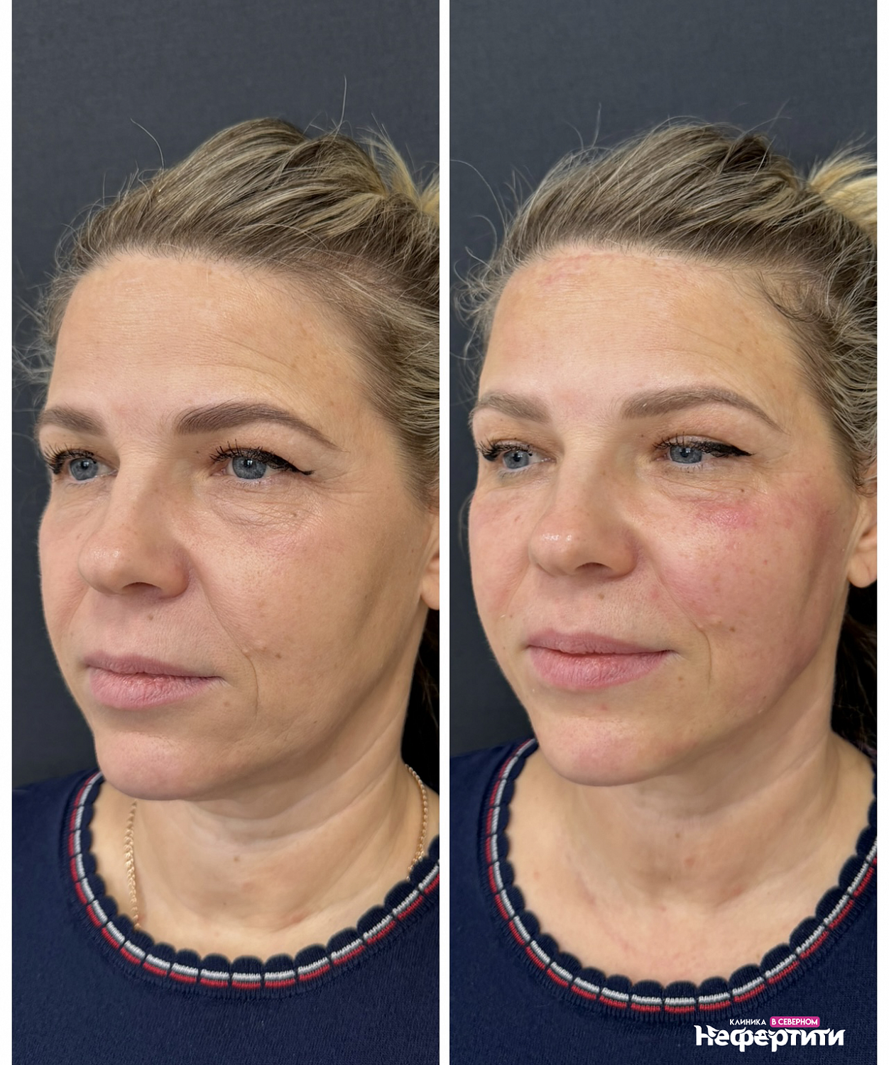 Volnewmer  — безоперационный лифтинг лица на монополярном RF 